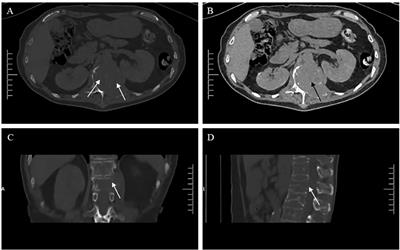 Multiple myeloma following bone metastasis of renal cell carcinoma: a case report